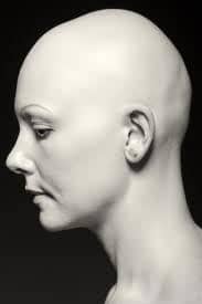Movehs - Alopecia universalis